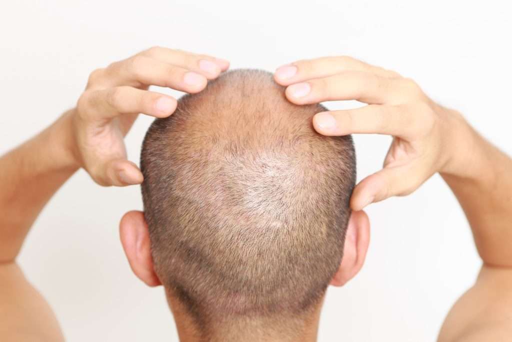 balding man